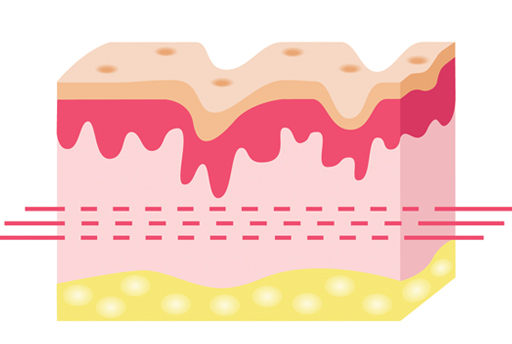 땡큐피부과 실리프팅