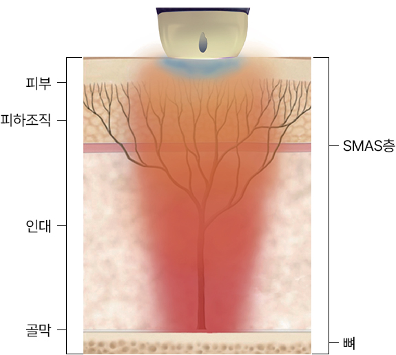 땡큐피부과 티타늄 리프팅