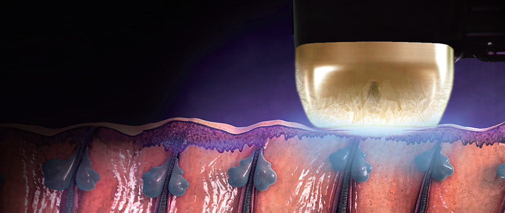 땡큐피부과 티타늄 리프팅