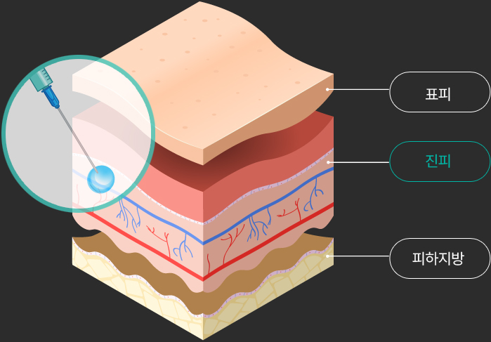 땡큐피부과 리쥬란힐러