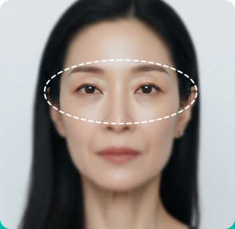 눈가 볼륨 부족형