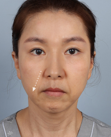 땡큐피부과 전후사진