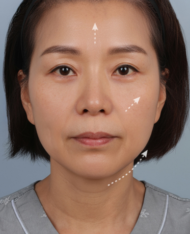 땡큐피부과 전후사진