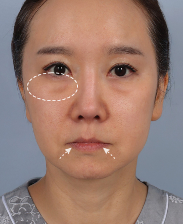 땡큐피부과 전후사진