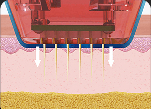 땡큐피부과 버츄RF