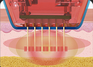 땡큐피부과 버츄RF