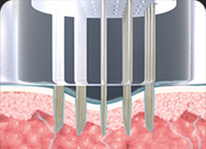 땡큐피부과 포텐자