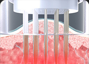 땡큐피부과 포텐자