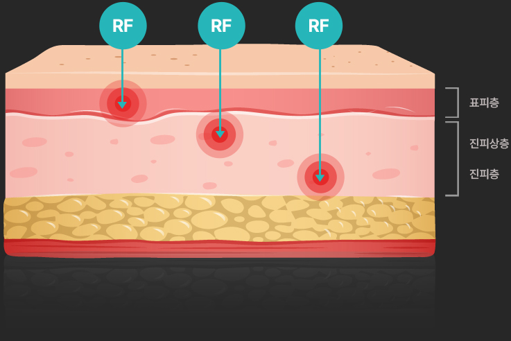 땡큐피부과 포텐자