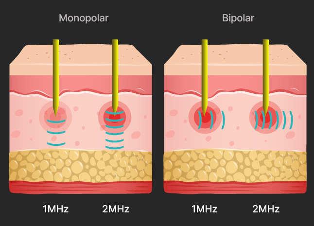 땡큐피부과 포텐자
