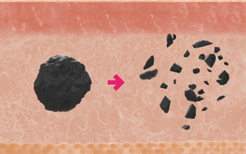 땡큐피부과 문신제거