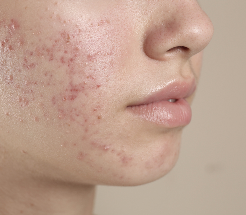 땡큐피부과 애플레이저