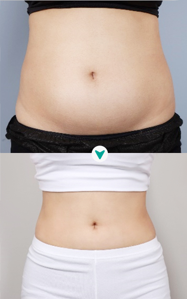 디에이징클리닉 전후사진