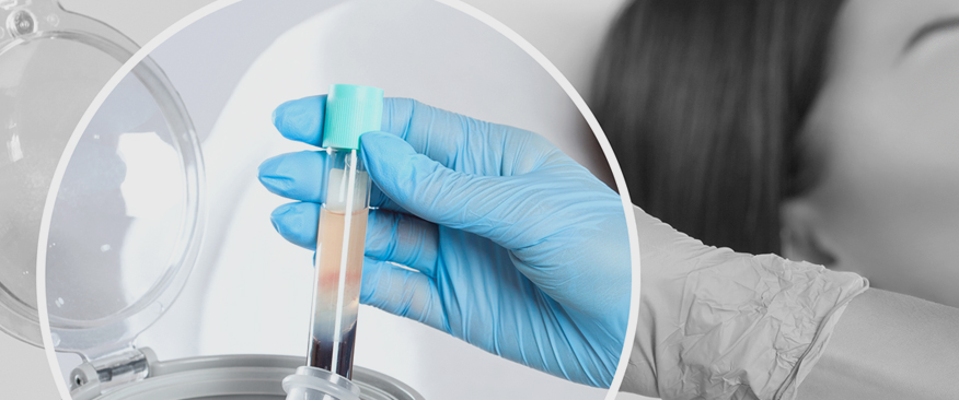 고농축 자가 줄기세포